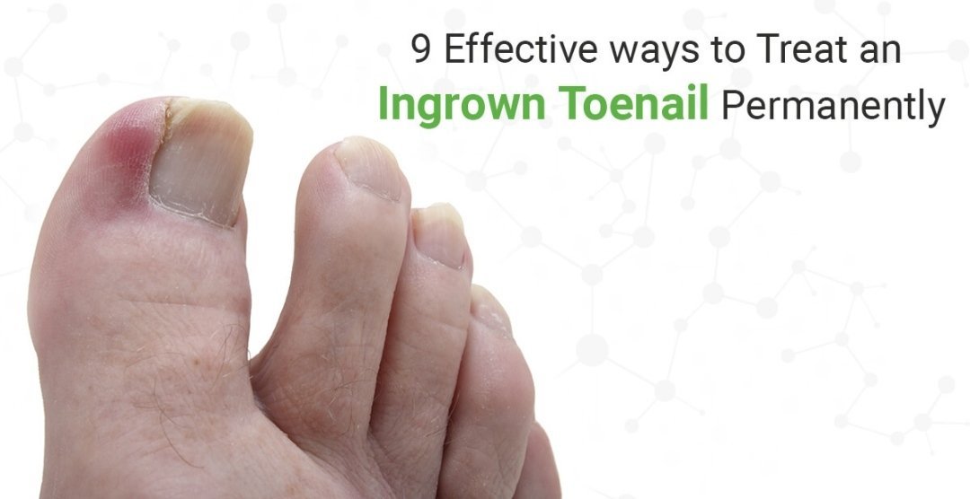 Home Remedies For Ingrown Toenail