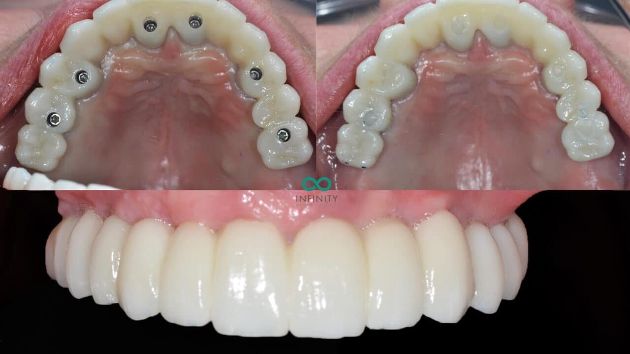 How dental implants are transforming full-mouth restoration treatments