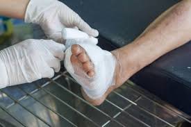 How Wound Care Specialists Prevent Infection in Foot Injuries