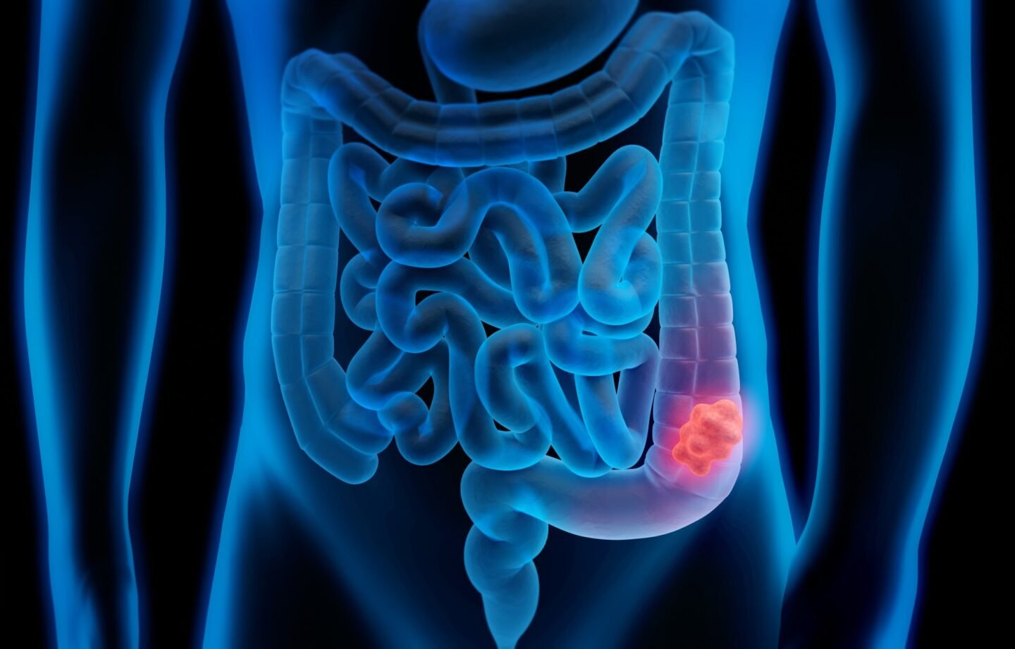 How Colon Cancer Develops and What You Can Do to Reduce Your Risk