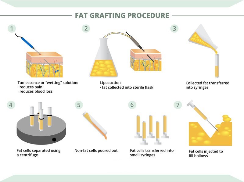 How Fat Grafting Improves the Aesthetic Look of Your Breasts