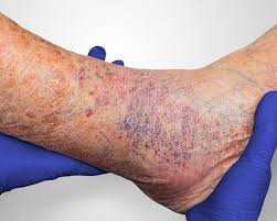 How Vascular Specialists Help Treat Chronic Leg Wounds