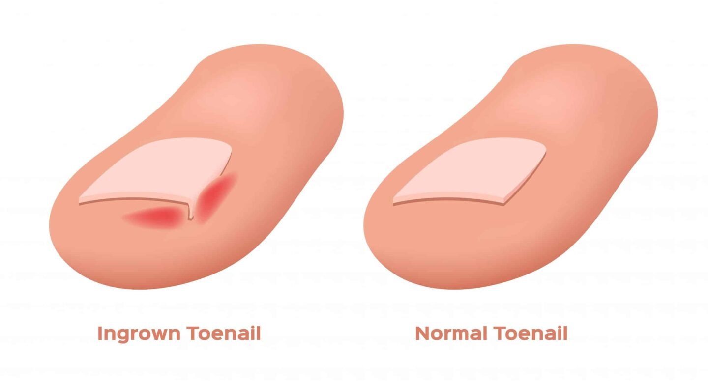 How to Avoid Ingrown Toenails: Tips for Proper Nail Care