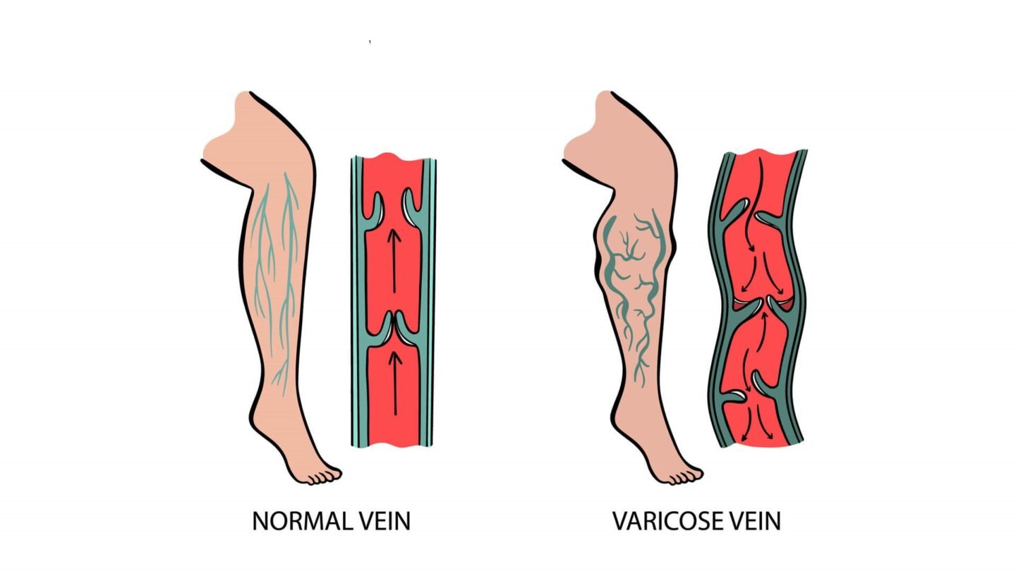 Exploring the Latest Advances in Cosmetic Vein Treatments